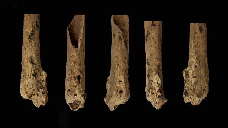 患者腿部骨骼的五种不同视图，显示愈合的截肢表面。