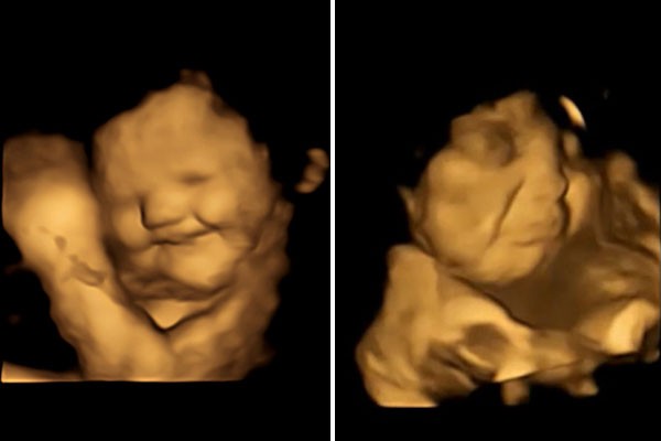 A composite of 4D scan images of two foetuses showing laughter- and cry-face reactions after being exposed to different flavors.
