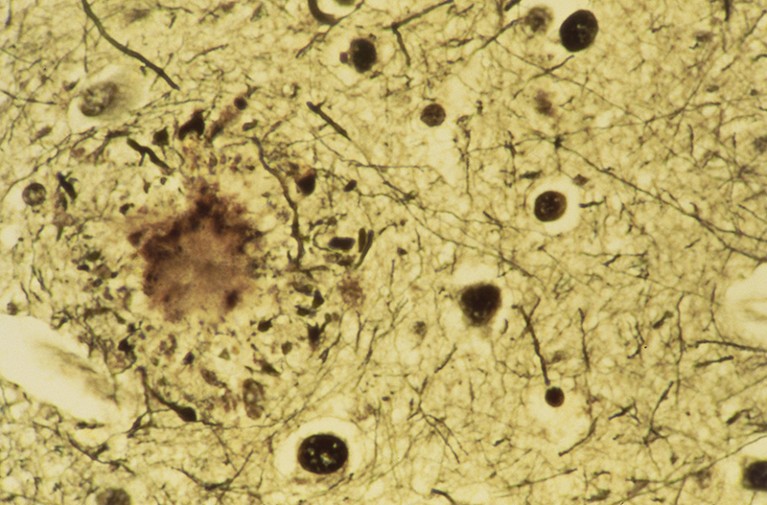 Light micrograph of human brain tissue in Alzheimer's disease, showing a senile plaque (dark circular lesion at left).
