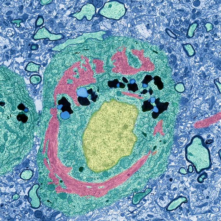 Neurone nella malattia di Alzheimer, micrografia elettronica a trasmissione colorata.