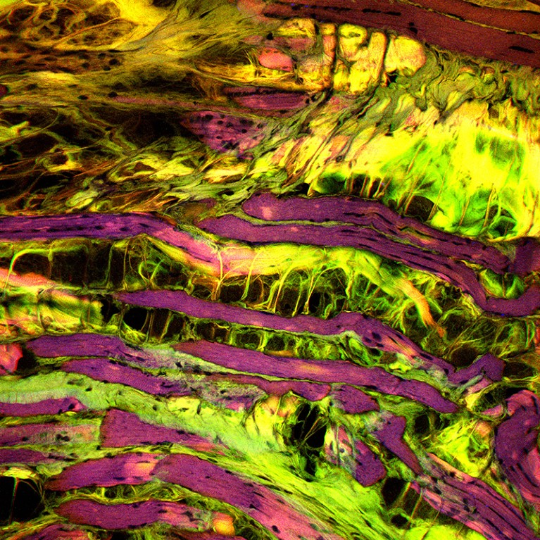 Confocal light micrograph images of a section through muscle tissue affected by muscular dystrophy