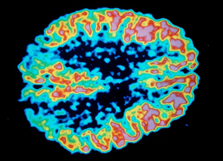 Colour-coded PET scan of a brain with Alzheimer's disease