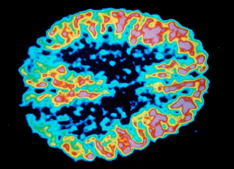 Colour coded PET scan of a brain with Alzheimer's disease