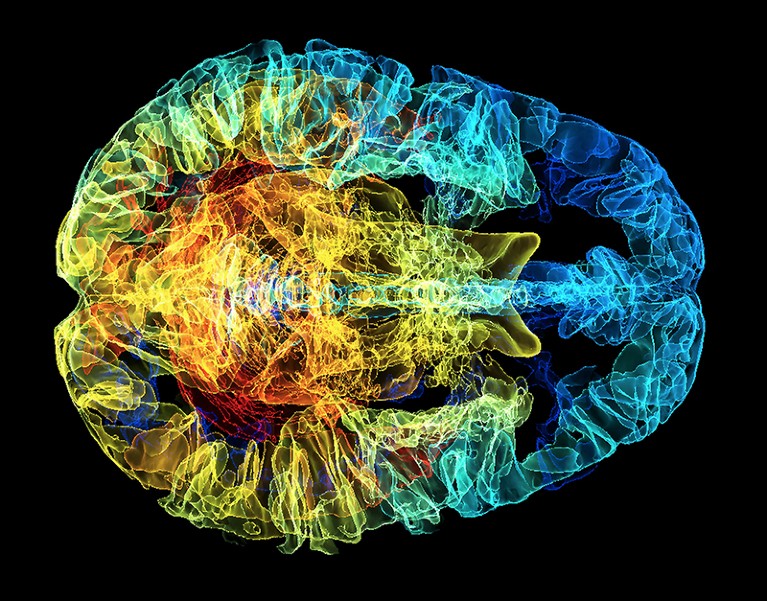 A coloured 3D MRI scan from above shows the brain's ventricles and cerebral-cortex folds.