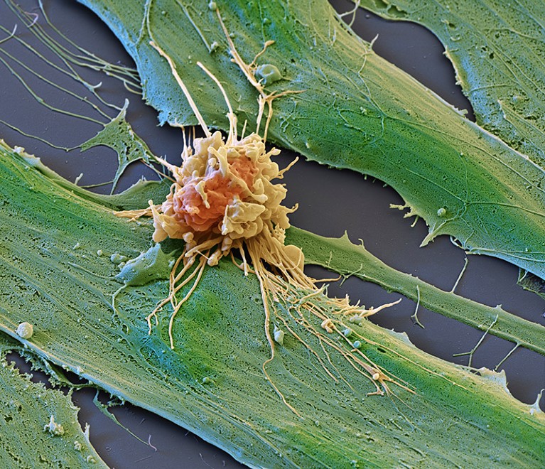 Coloured scanning electron micrograph of a rhabdomyosarcoma cancer cell being attacked by a chimeric antigen receptor T-cell