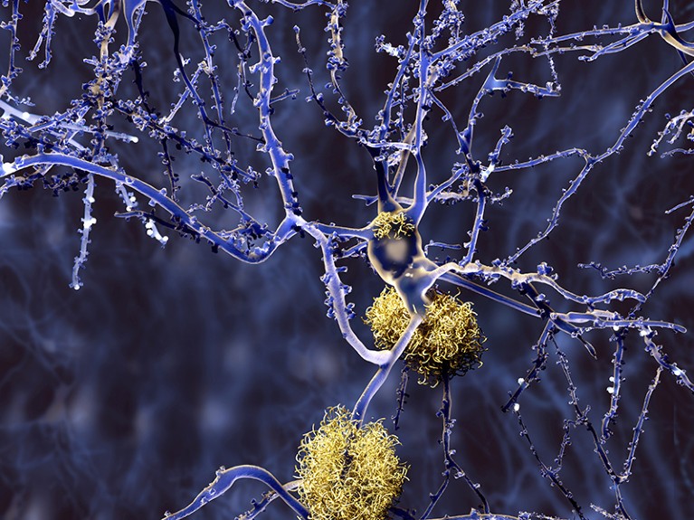 Computer rendering of amyloid plaques between neurons.  Amyloid plaques are hallmarks of Alzheimer's disease.