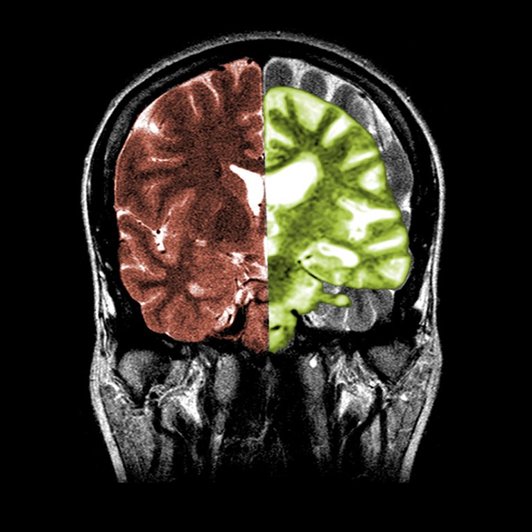 Split image showing MRI scans of a normal brain on left and an Alzheimer's brain on right