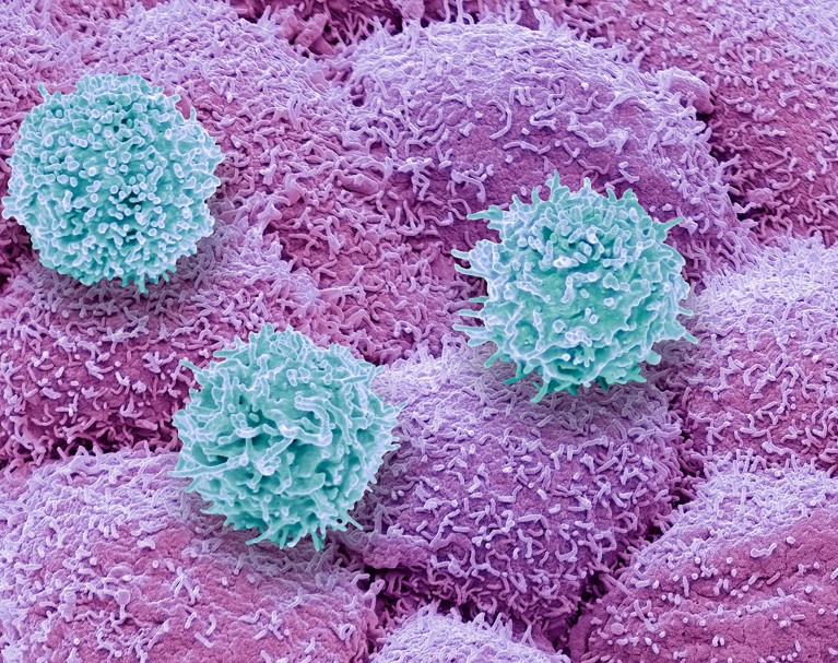 Composite coloured scanning electron micrograph (SEM) of T-cells and prostate cancer cells (pink)