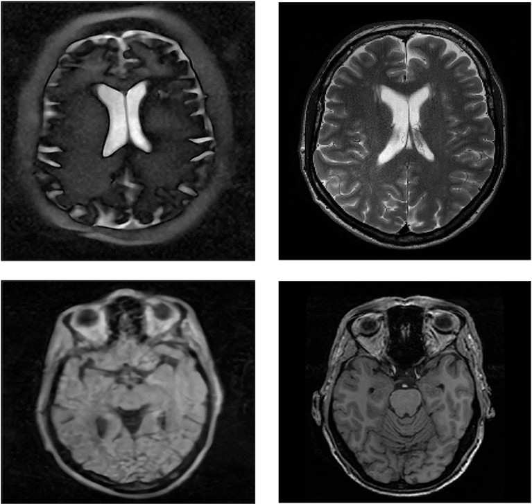 Images from the low-field 0.047 T MRI system (left), and images from the same individual from a 3 T clinical system.
