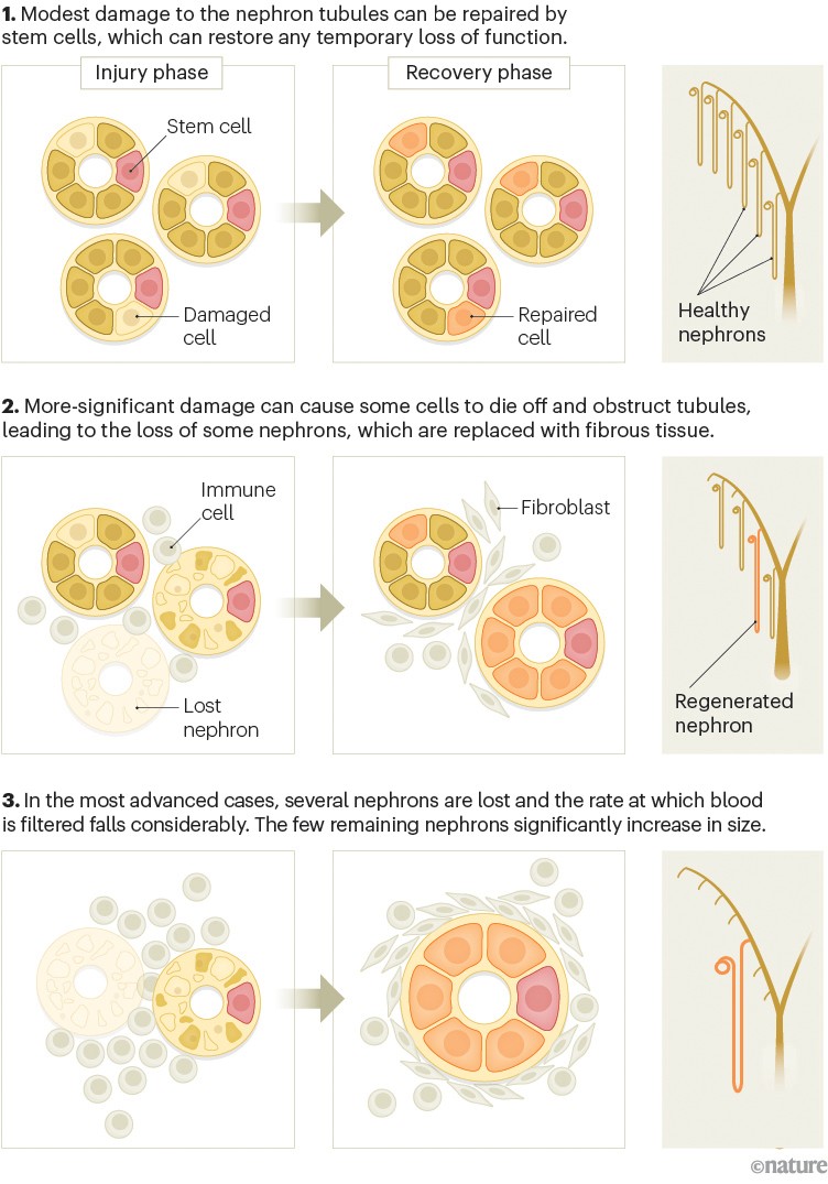 Graphic showing how the nephrons respond to injury at a cellular level