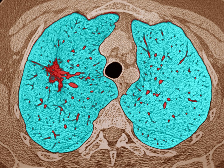 Scansione TC colorata in sezione assiale attraverso il torace che mostra i polmoni colorati in blu e l'adenocarcinoma lepidico in rosso