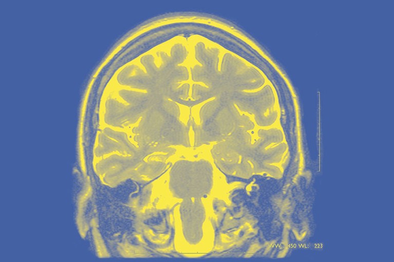 MRI scan of a patient with partial drug-resistant Epilepsy