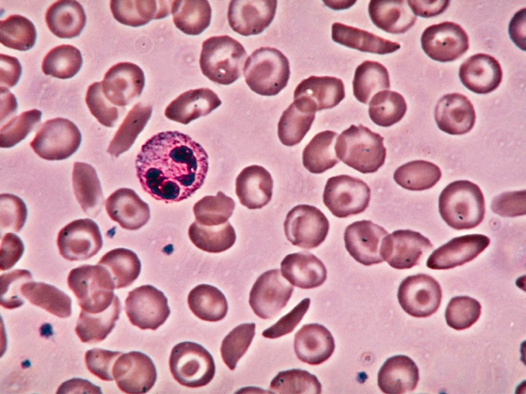 LM of deformed red cells in sickle cell disease.