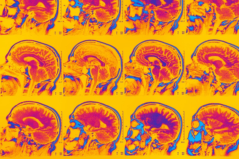 MRI scan of brain.