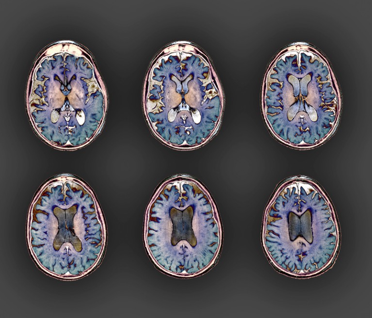 Early-onset Alzheimer's disease, MRI scan