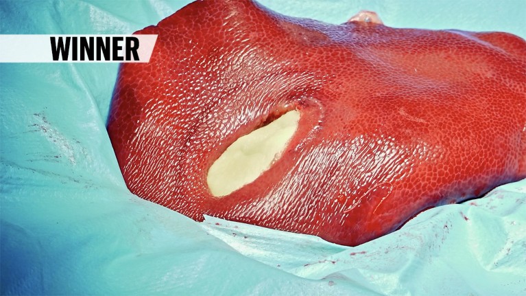 A liver with a plugged area, free of blood.