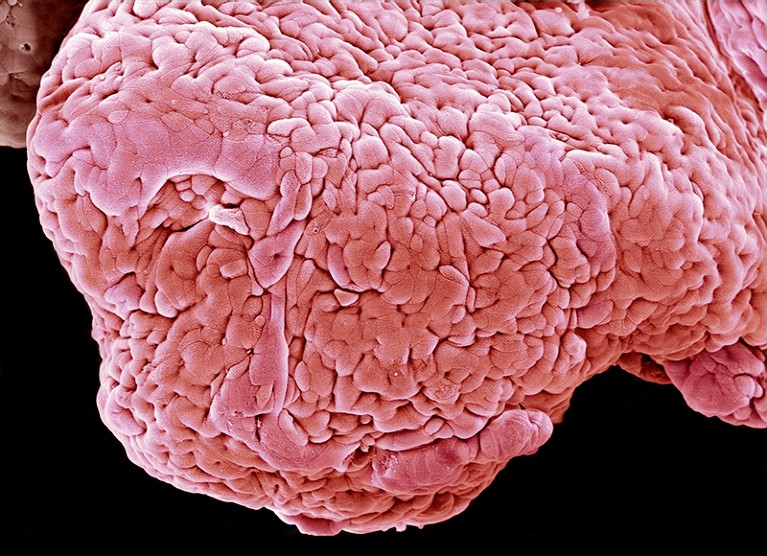 Una micrografía electrónica de barrido en color de una sección del intestino humano con colitis ulcerosa.