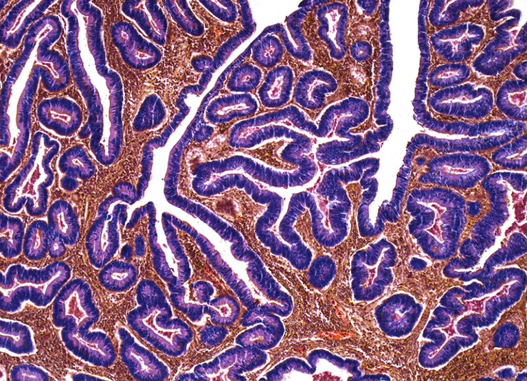 Light micrograph (LM) of a section through an adenocarcinoma (cancer) of the colon, part of the large intestine.