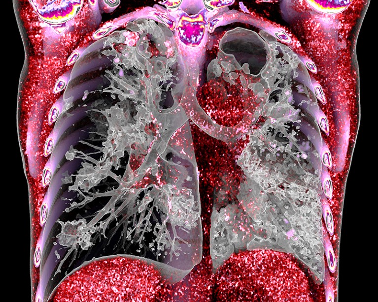 3D coloured computed tomography (CT) scan of the chest of a patient with pulmonary tuberculosis.