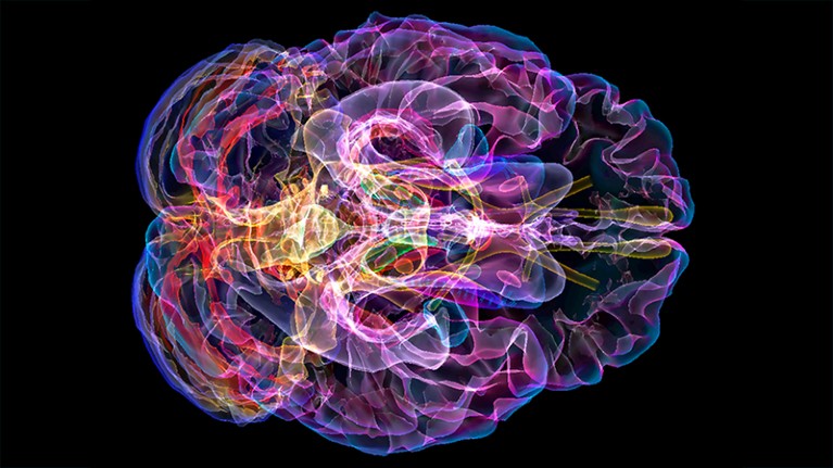 Coloured 3D magnetic resonance imaging (MRI) scan of the brain of a patient with Alzheimer's disease.