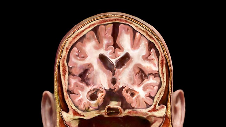 Visualization showing a brain affected by Alzheimer's disease.