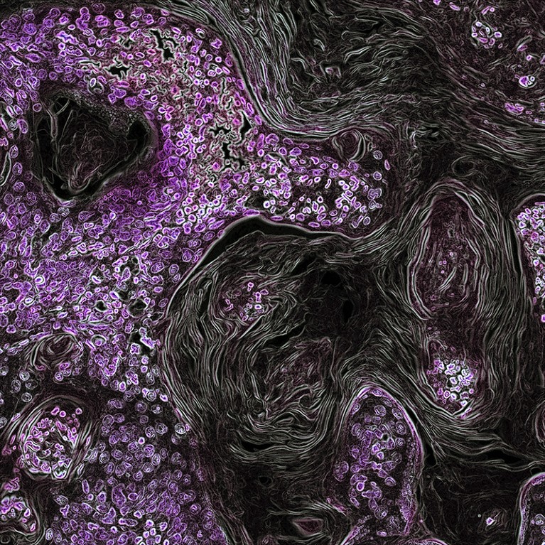 Black and purple microscope image showing lung cancer cells (purple)