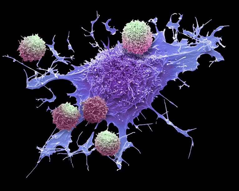 Composite coloured scanning electron micrograph (SEM) of T-cells and a lymphoma cancer cell (purple).