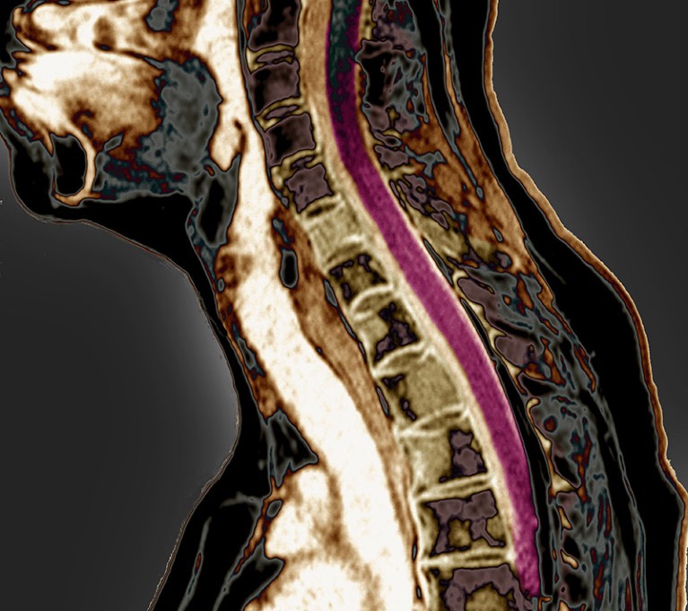 Coloured MRI scan of the side view of a person's neck, in brown, white and grey with a streak of purple.