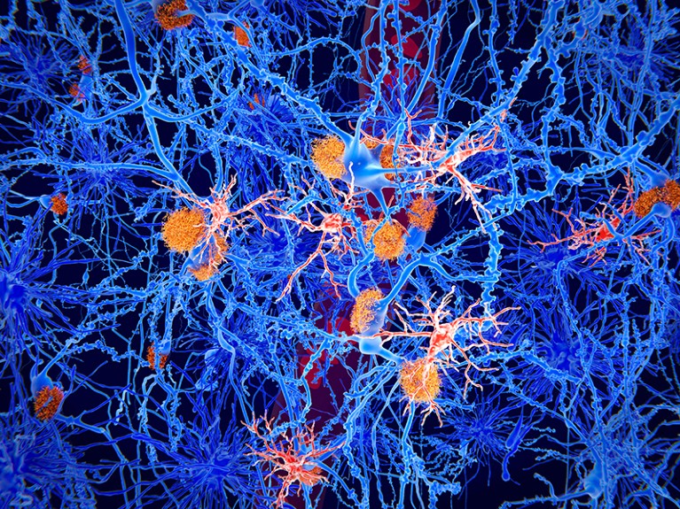 Illustration of amyloid plaques (orange) and microglia cells (red) among brain cells in a case of Alzheimer's disease.