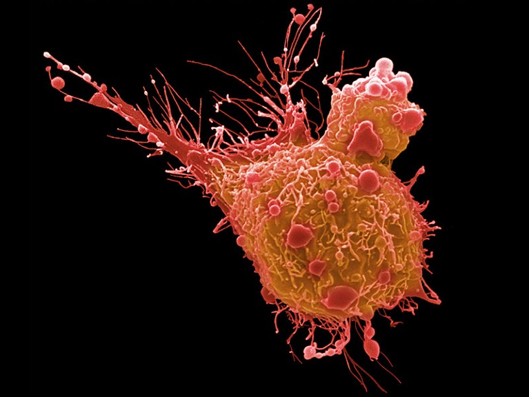 Coloured scanning electron micrograph of a bladder cancer cell.