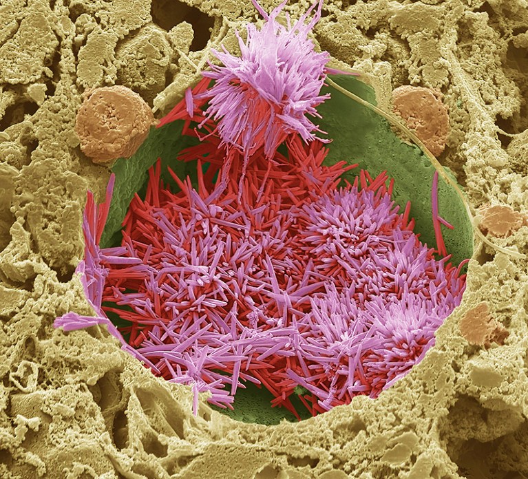 Coloured SEM of cholesterol crystals (red) within a lipid droplet in a human liver.