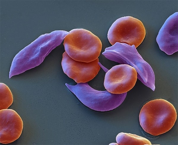 An electron microscopy image shows normal, round and plump red blood cells next to red blood cells that are thin and squished as a result of sickle-cell disease.