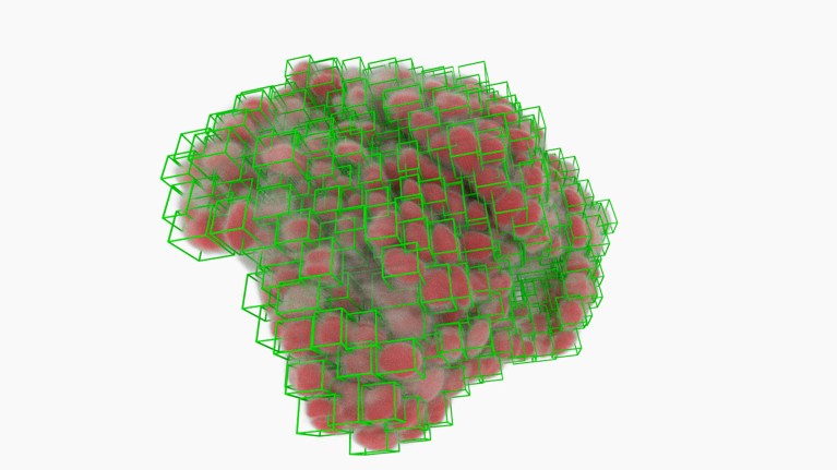 clump of cancer cells, each picked out in a green box by an algorithm