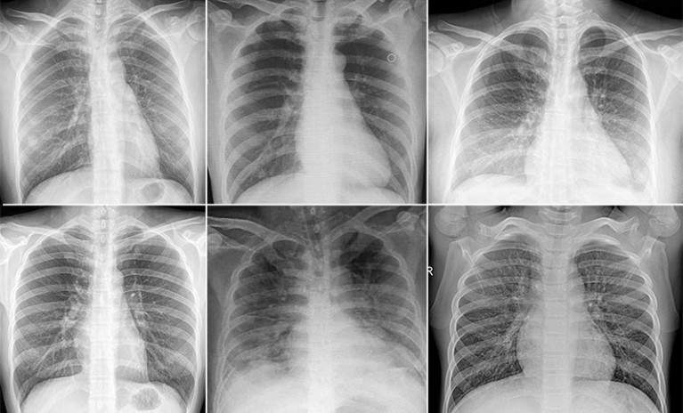 A composite of 6 examples of chest x-rays from datasets used for training AI of two normal patients, two with COVID-19 & two with pneumonia.