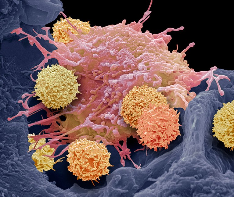 Composite coloured scanning electron micrograph (SEM) of T-cells (small round) and a cervical cancer cell (Hela)