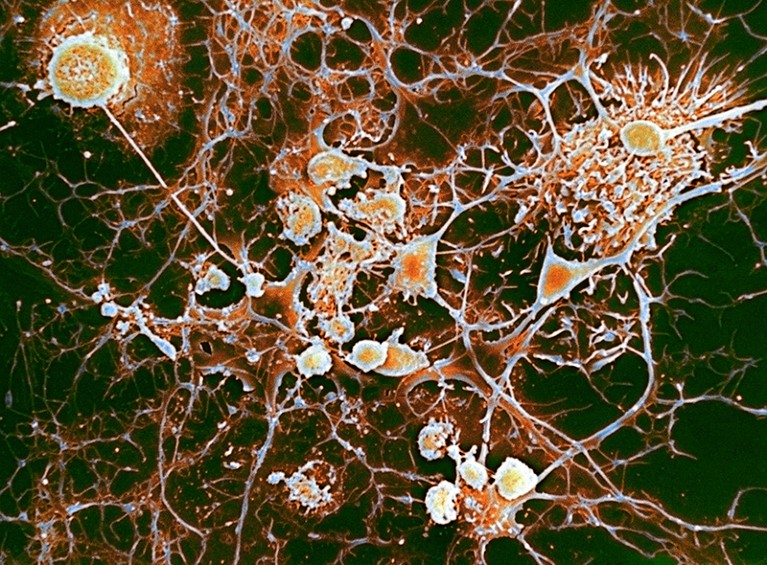 Coloured scanning electron micrograph (SEM) of multiple sclerosis, microglial cells ingesting oligodendrocytes.