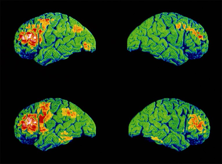 Coloured Positron Emission Tomography brain scans of a schizophrenic shown at bottom versus normal patient at top