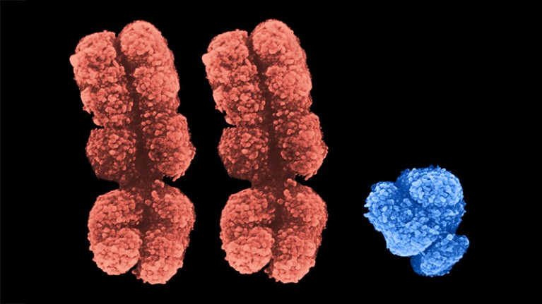 Composite Scanning Electron Micrograph (SEM) of human chromosomes, showing two X and one Y chromosome, as is found in Klinefelter syndrome.