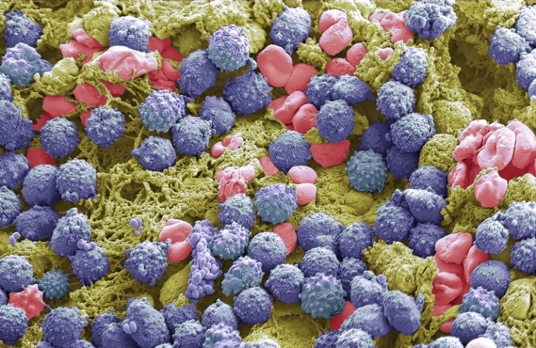 Coloured scanning electron micrograph (SEM) of inflammatory cells which occur in any kind of tissue including the skin surface, in the lungs, brain, teeth, kidneys, and tonsils.