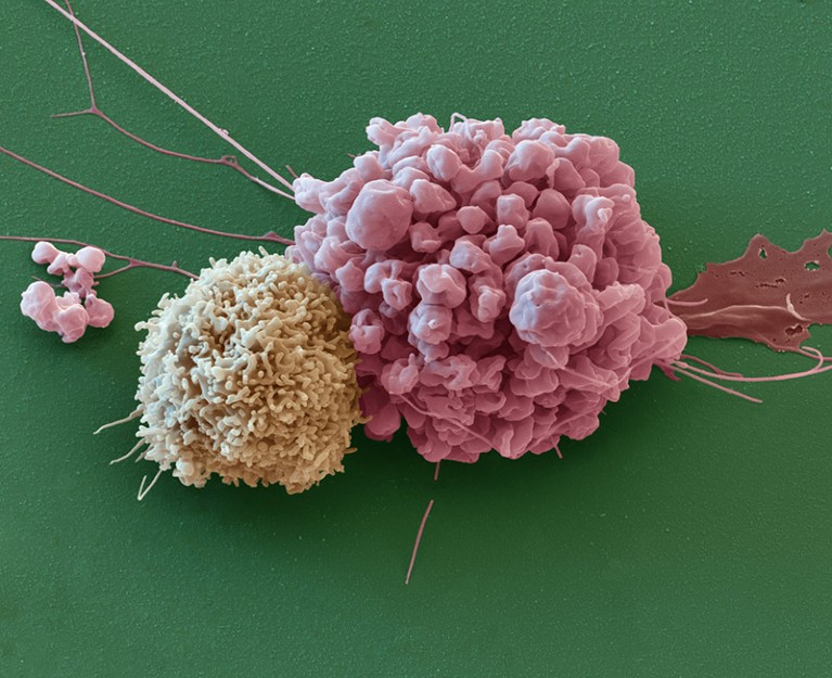 Coloured scanning electron micrograph of ependymoma cell and a natural killer cell