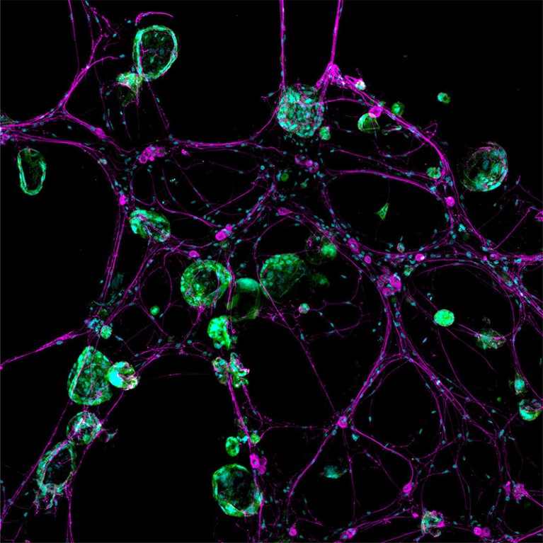 A view of genetically engineered mini-organs where pancreatic cancer cells interact with nerve cells