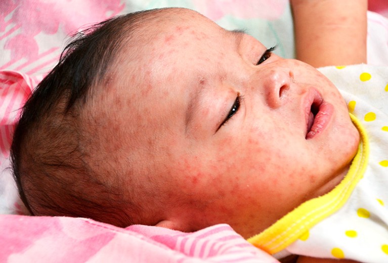 有面部皮疹的婴儿特写。