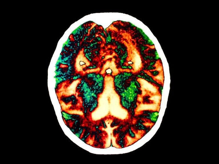 Color computed tomography scan of a brain affected by Alzheimer's disease.
