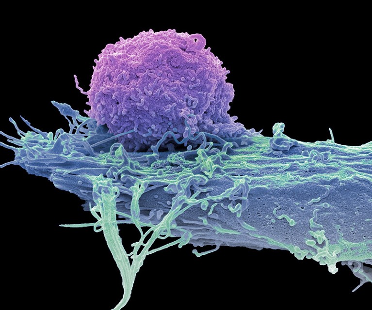 Coloured scanning electron micrograph (SEM) of a T-cell ( purple) and a brain cancer cell ( oligodendroglioma).
