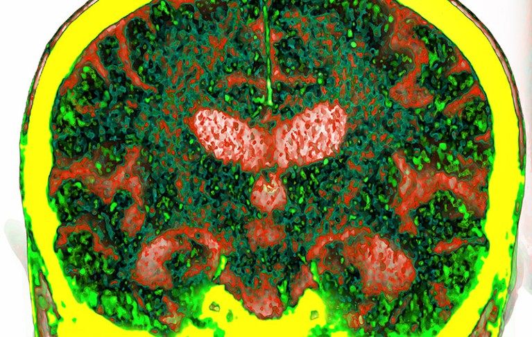 Coloured CT scan of a coronal section through the brain of a patient with Alzheimer's disease.