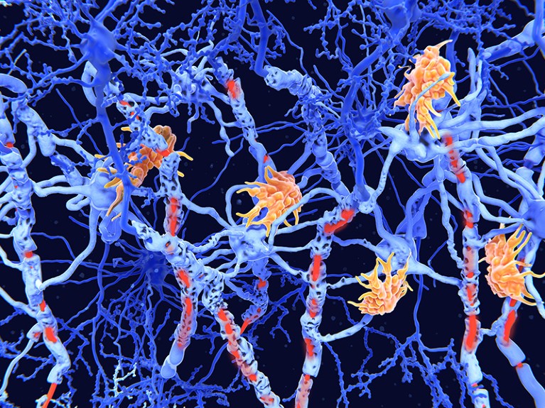 Illustration of nerve cells damaged by the degenerative disease multiple sclerosis.