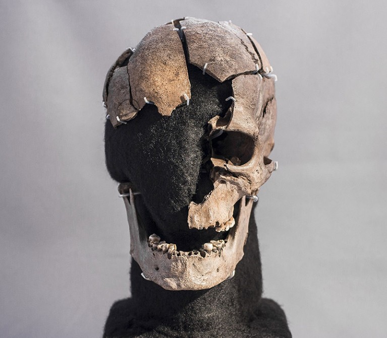 Fragmenten van een schedel en kaakbeen, waarbij de rechter oogkas en cheerk ontbreken, gemonteerd op een zwarte standaard.