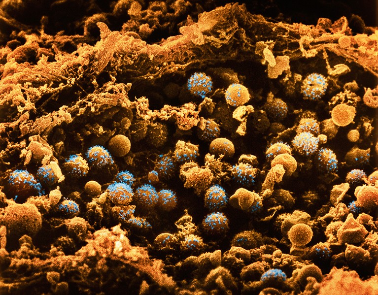 Round orange cells, some covered with blue secretions, are seen in an islet of Langerhans from the pancreas