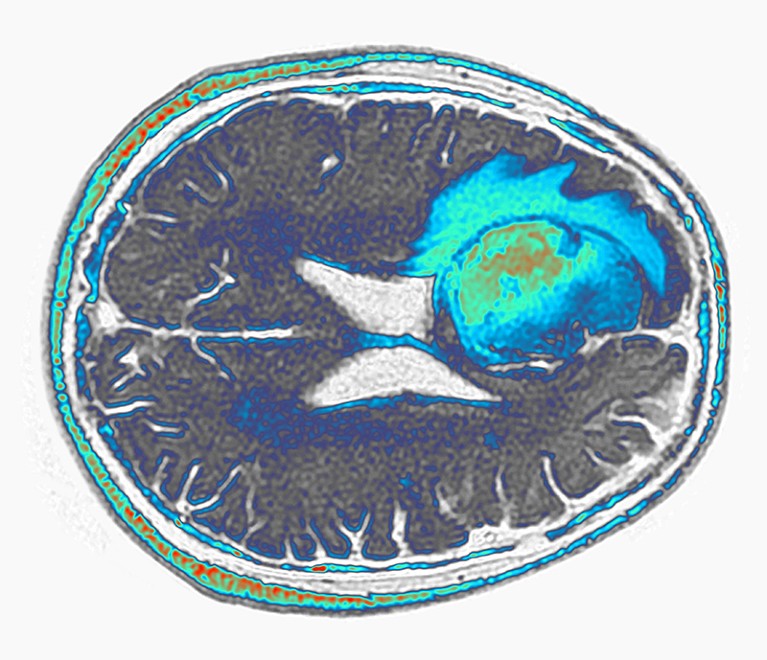 Coloured FLAIR (fluid-attenuated inversion recovery) magnetic resonance imaging scan (MRI) of an axia section through a human brain showing a glioblastoma affecting the frontal lobe.