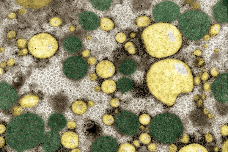 Coloured TEM of a section through liver tissue in a case of hepatic steatosis (fatty liver disease).